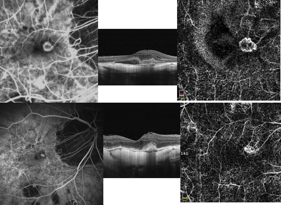 degenerazione maculare neovascolare nella  miopia patologica